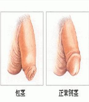 包茎和包皮过长区别是什么