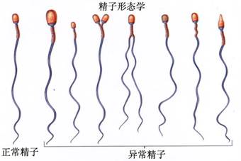 男性少精症常见发病因素有哪些