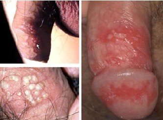 铜川前列腺炎会危害男性性功能吗?